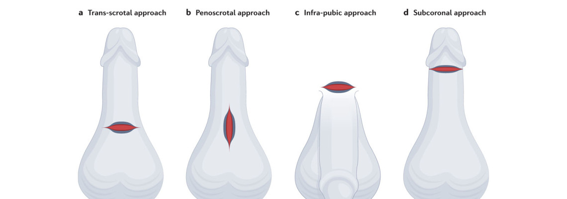 Penile Compression Devices