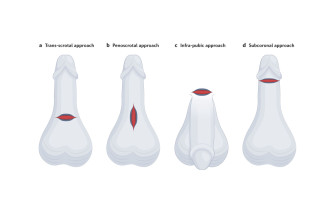 Penile Compression Devices